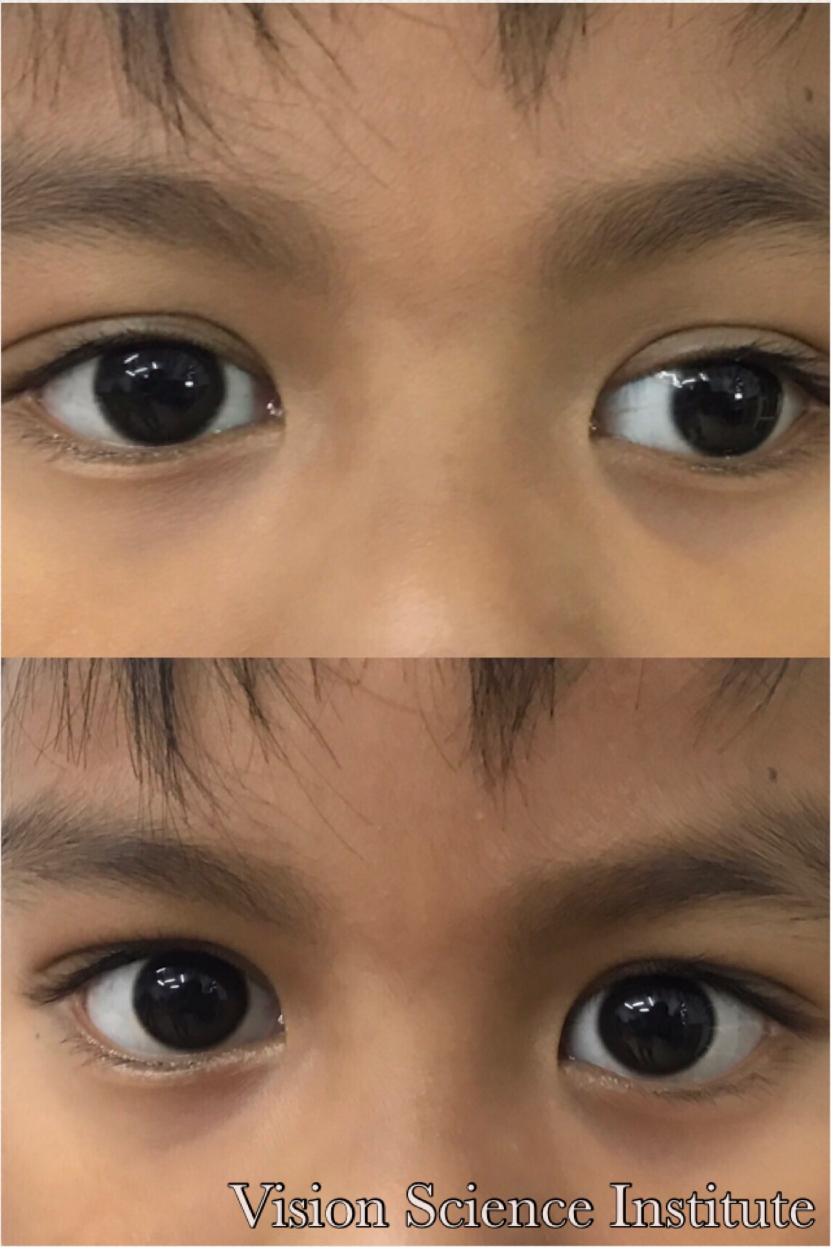 strabismus-vision-therapy-philippines